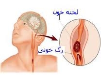Ø¯Ø§Ù†Ù„ÙˆØ¯ Ú©ØªØ§Ø¨ Ø§Ù‚Ø¯Ø§Ù…Ø§ØªÛŒ Ø¨Ø±Ø§ÛŒ Ø¬Ù„ÙˆÚ¯ÛŒØ±ÛŒ Ø§Ø² Ø³Ú©ØªÙ‡ Ù…ØºØ²ÛŒ